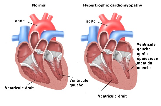 Cas de HCM